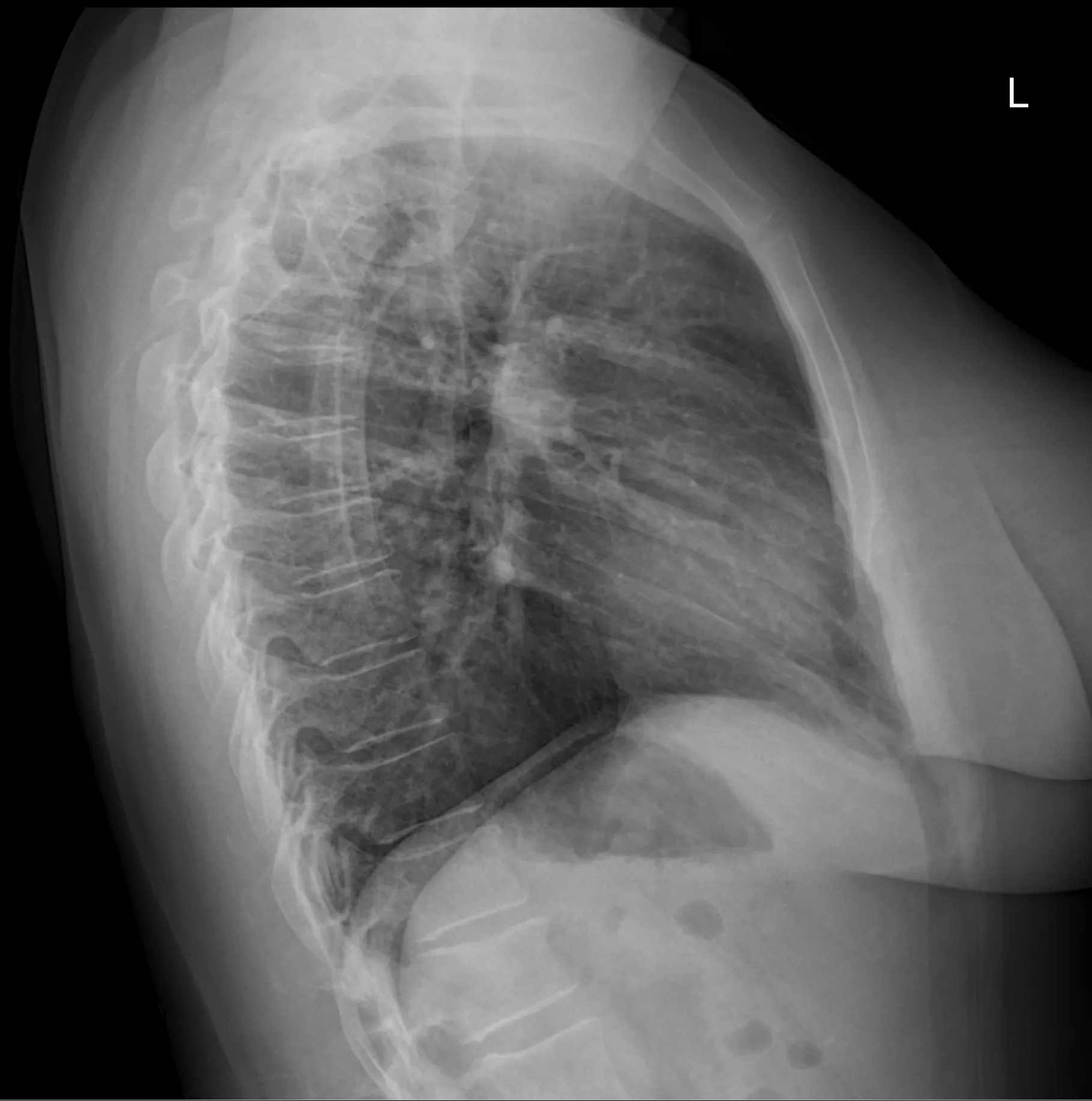 Radiografía lateral de tórax procesada por el pipeline Med-IA