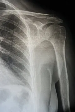 Análisis radiológico con IA